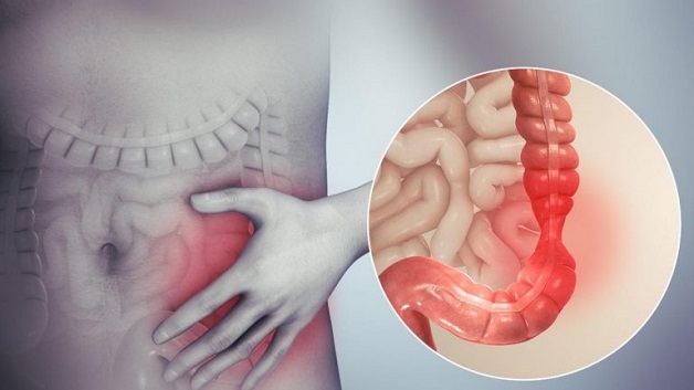 Loại thực phẩm gây ung thư ruột nguy hiểm gấp 10 lần thuốc lá, rượu bia, hạn chế nếu không ruột sớm “mủn như bùn”- Ảnh 1. Loại thực phẩm gây ung thư ruột nguy hiểm gấp 10 lần thuốc lá, rượu bia, hạn chế nếu không ruột sớm “mủn như bùn”- Ảnh 1.